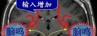 60岁主妇常听见“耳边乐曲” 台湾耳鸣权威诊治发现:原来是罕见脑鸣症